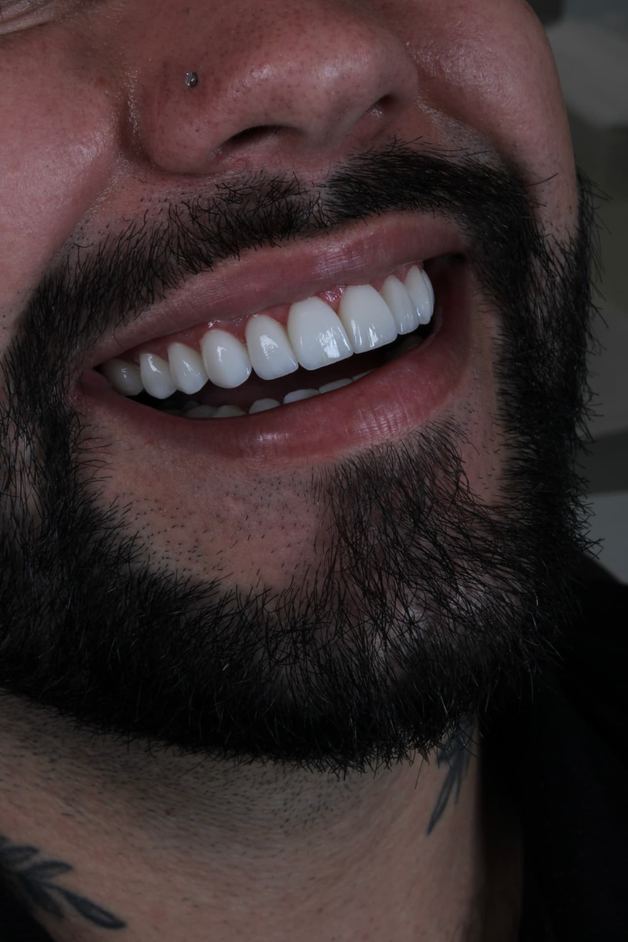 Sorriso em porcelana de paciente do Dr. Mateus