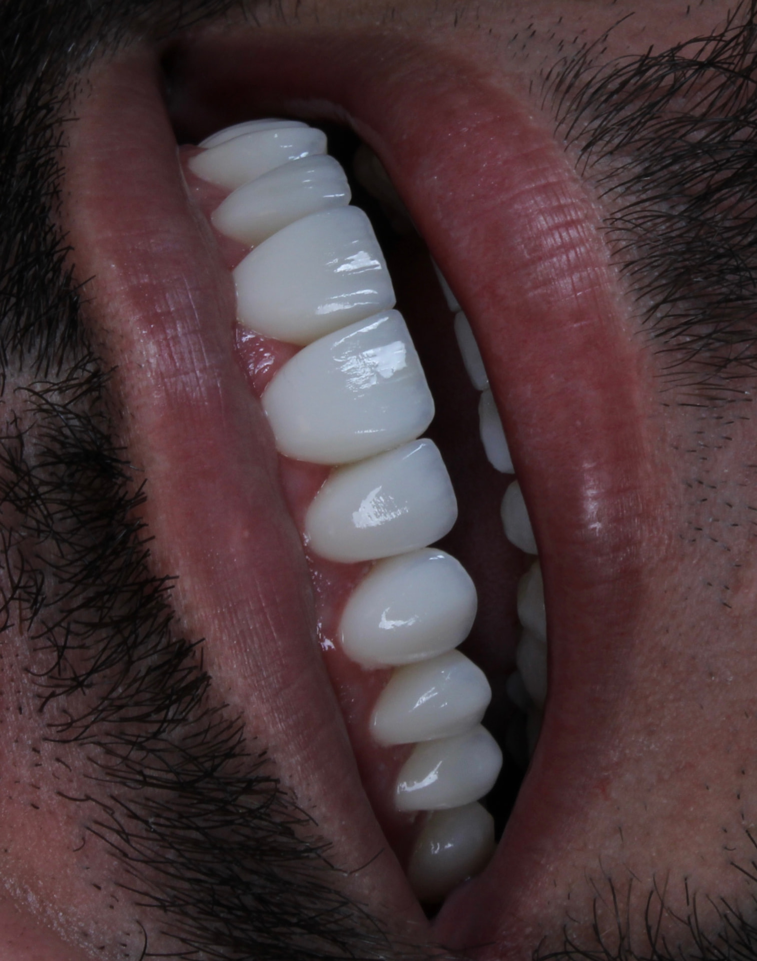 Detalhe do sorriso em porcelana de paciente do Dr. Mateus