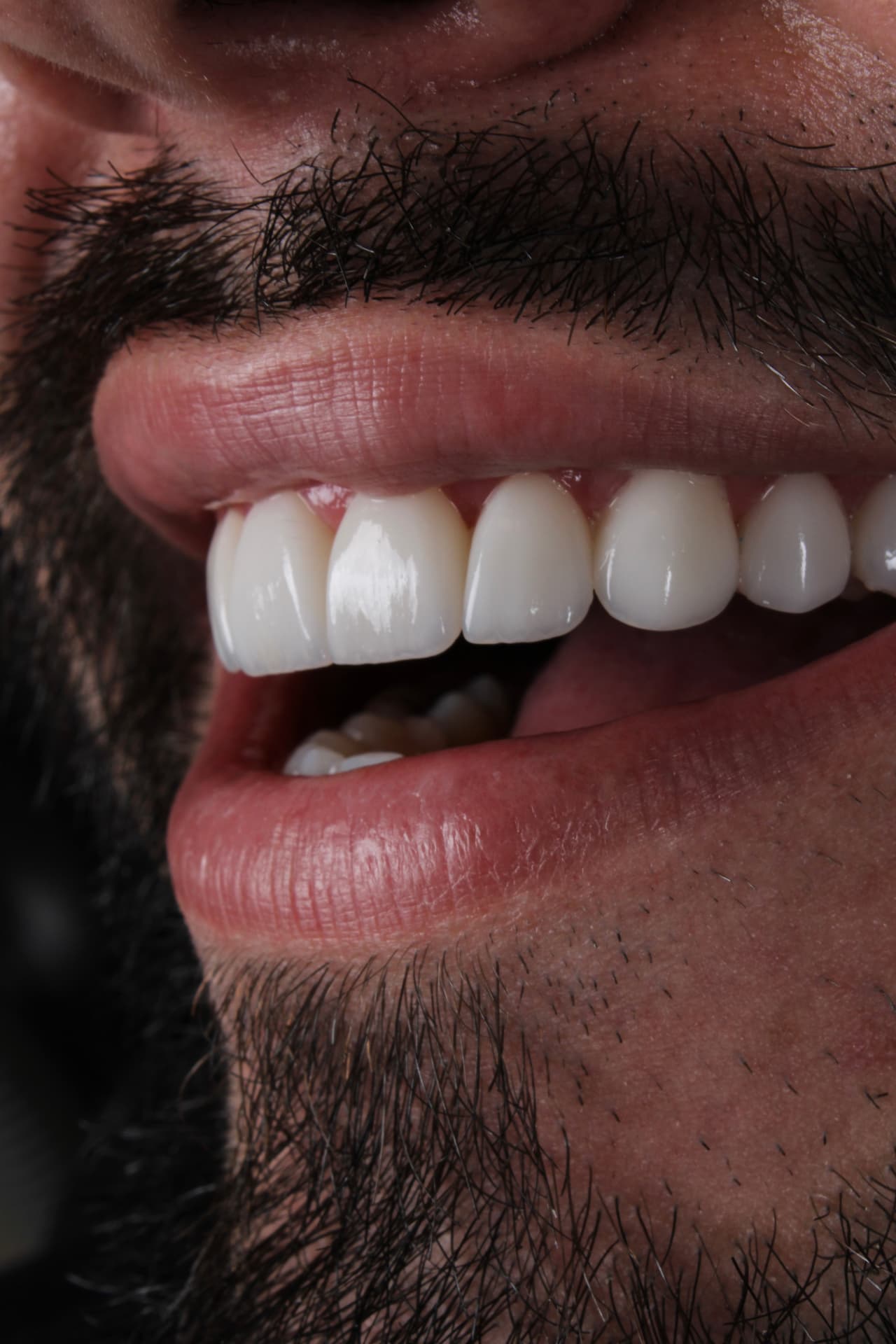 Sorriso em porcelana de paciente do Dr. Mateus, vista lateral