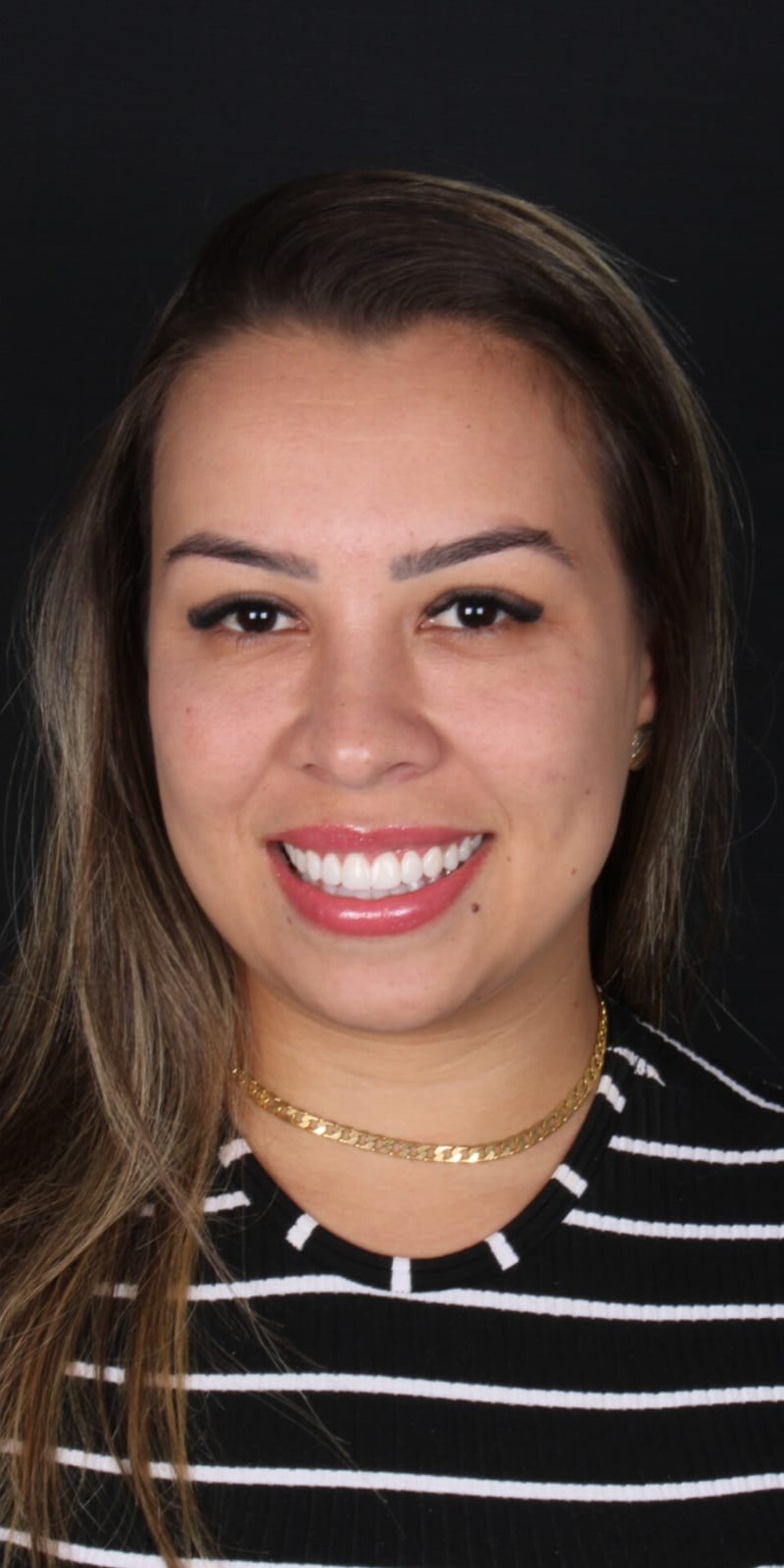 Comparação antes e depois de reabilitação estética — depois